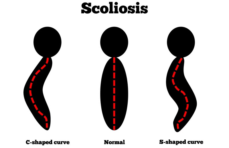 Medicine Hat, AB scoliosis treatment